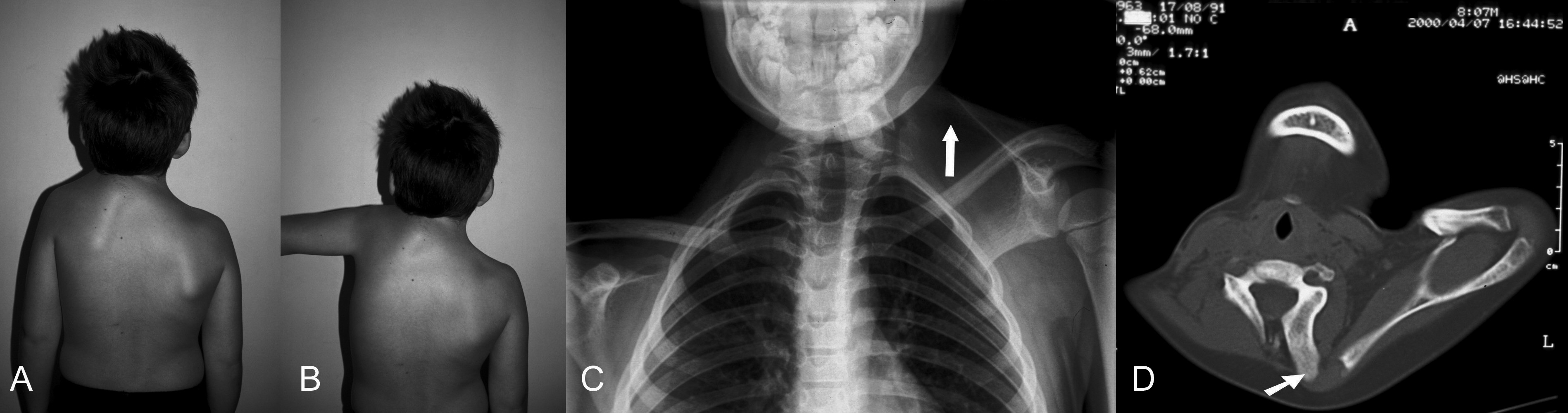 Abb. 4-67: Junge mit einer Sprengel’schen Deformität (A-B), Schulterhochstand (C), das CT zeigt ein Os omovertebrale (C&D)