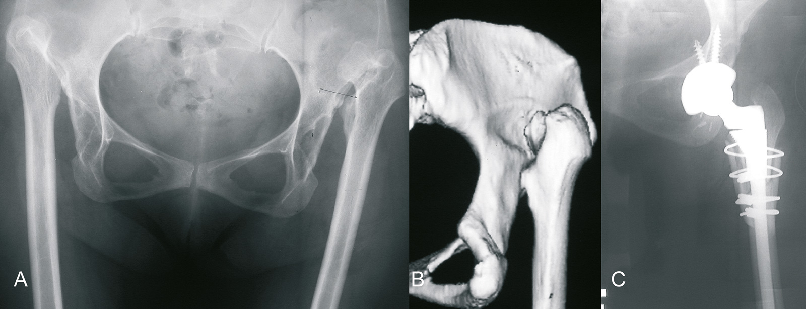 Abb. 1-12: Hüftdysplasie: Beckenübersichtsaufnahme und 3-D CT-Rekonstruktion (A,B). Röntgenbild nach Implantation einer S-ROM Hüftprothese und Verkürzungsosteotomie (C)