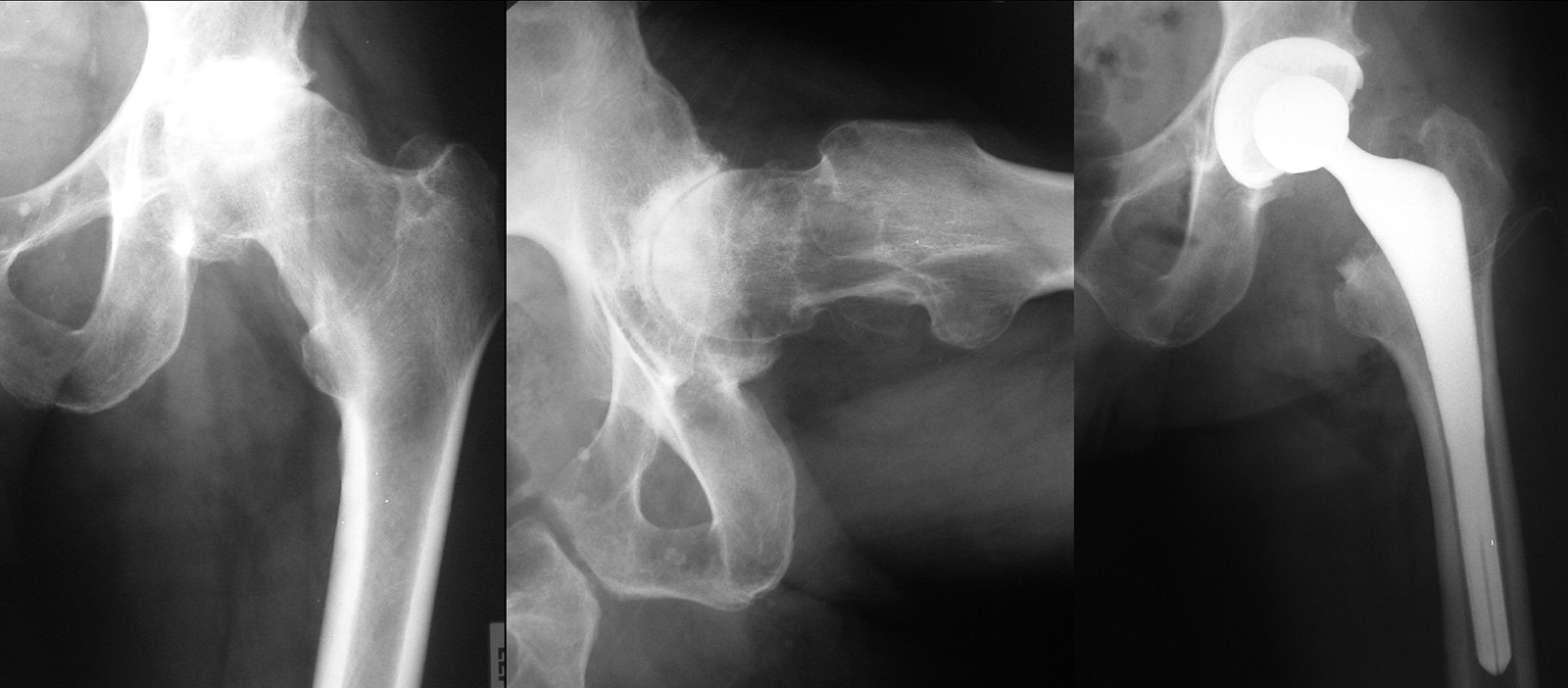 Abb. 1-14: Natives Röntgenbild einer primären Hüftgelenksarthrose (A,B), die mit einer zementfreien Hüftprothese versorgt wurde (C)