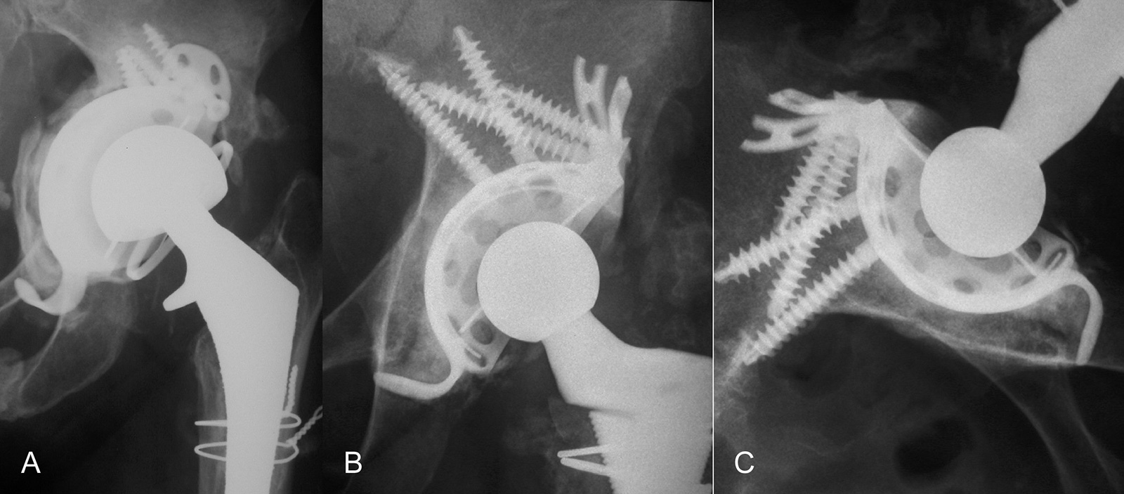 Abb. 1-23:  Präoperatives  Röntgenbild  einer  Schaft-  und  Pfannenlockerung  (A).  Die  Defektrekonstruktion   erfolgte  mit  einem  Stützring  und  Fremdknochenspänen  (B,C).  Die  Abbildung  B  und  C  zeigen   die gute knöcherne Integration der Fremd