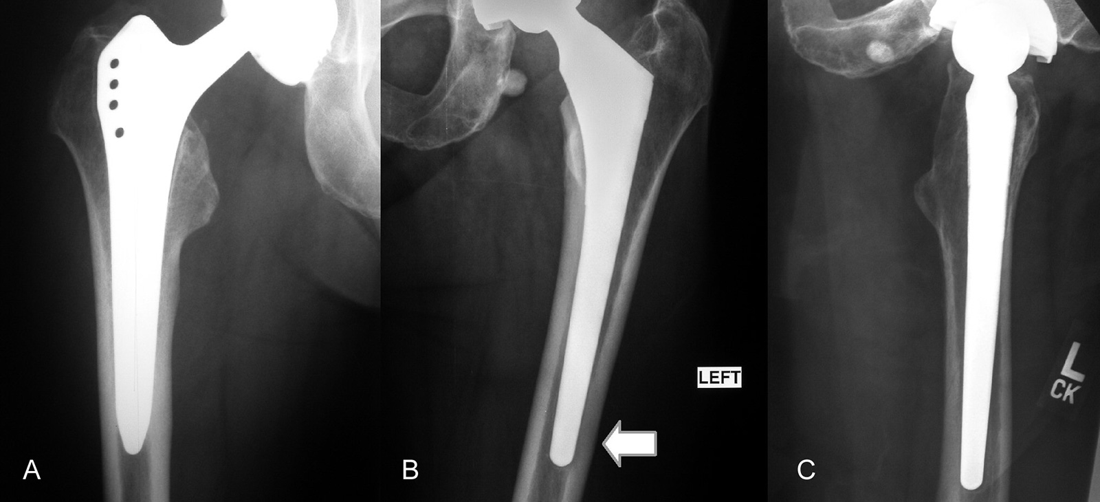 Abb. 1-24:  Patienten mit Schaftschmerzen aufgrund eines massiven Implantats mit distaler Verankerung  (A), bzw. eines varisch eingebrachten Prothesenschafts (B,C)