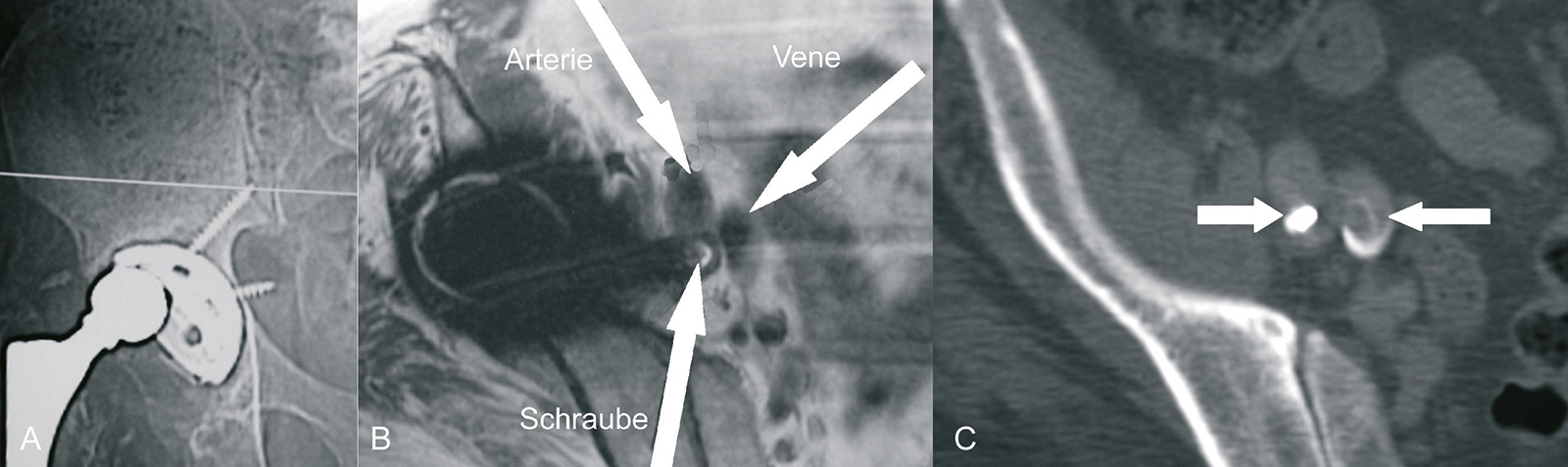 Abb. 1-27: Fehllage einer Schraube in unmittelbarer Nähe der A. femoralis (B,C)