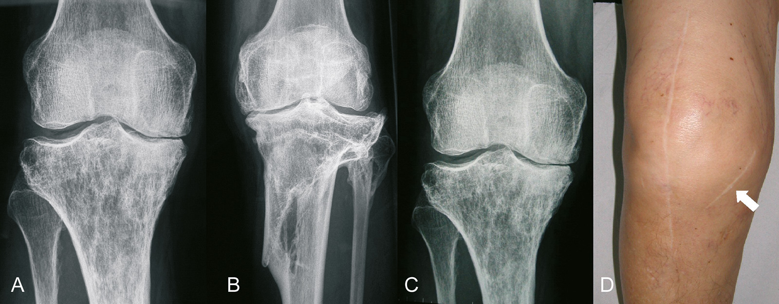 Abb. 1-28: Sekundäre Kniegelenksarthrose nach Therapie eines Riesenzelltumors (A), nach proximaler Tibiafraktur (B), nach Infektion (C) und nach offener Meniskektomie (D)