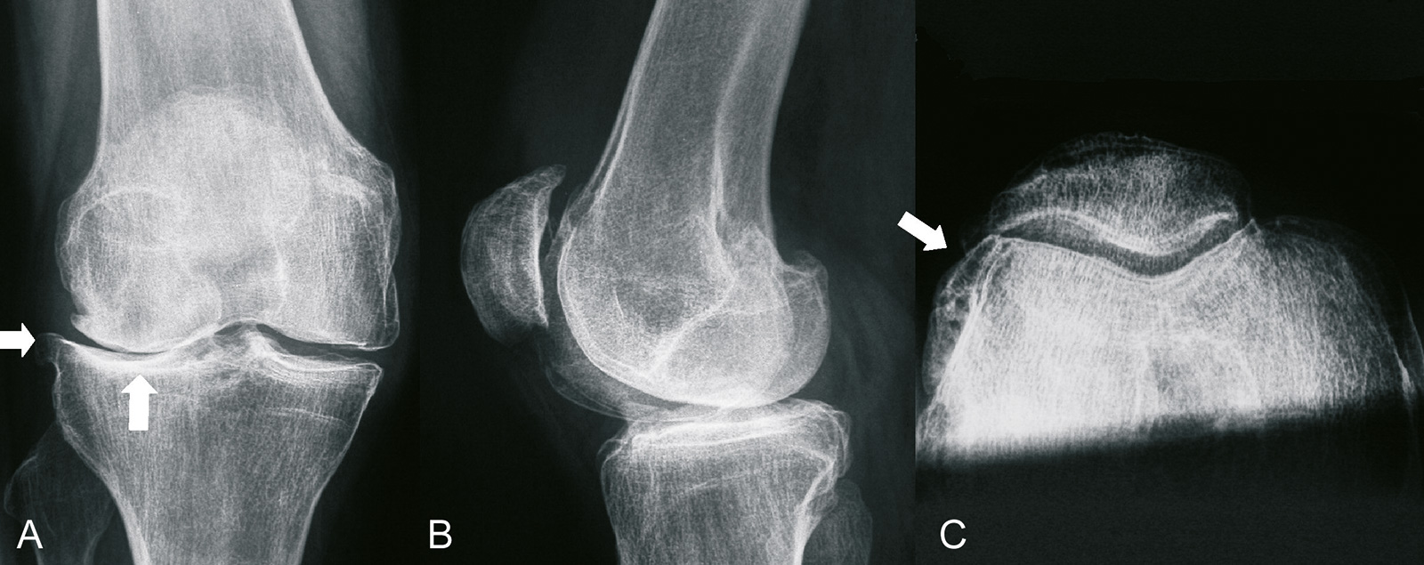 Abb. 1-30: Radiologische Zeichen einer Arthrose (A-C): Gelenkspaltverschmälerung, subchondrale Sklerosierung, Geröllzysten, laterale Osteophyten (A), u.a. entlang des lateralen Femurkondylus (C)