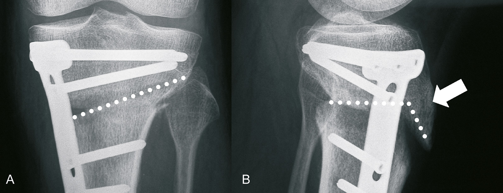 Abb. 1-35: Aufklappende Osteotomie: die Osteotomie verläuft ansteigend in Richtung auf die Spitze des Wadenbeinköpfchens (A), dabei verbleibt die Tuberositas tibiae am proximalen Fragment (B)