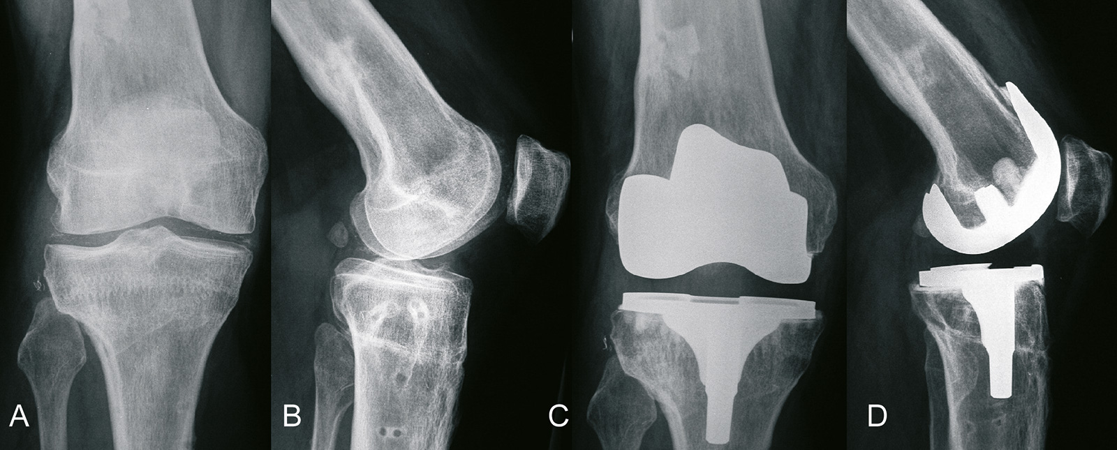 Abb. 1-38: Implantation einer Knieprothese (C,D) nach fehlgeschlagener Umstellungsosteotomie (A,B) (Eigentum des Instituts für Klinische Radiologie der Universität Münster)