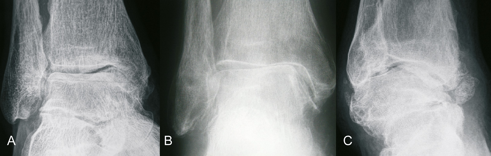 Abb. 1-48: Röntgenbild einer fortschreitenden Sprunggelenksarthrose mit zunehmender Fehlstellung und Subluxation des Talus (A-C)