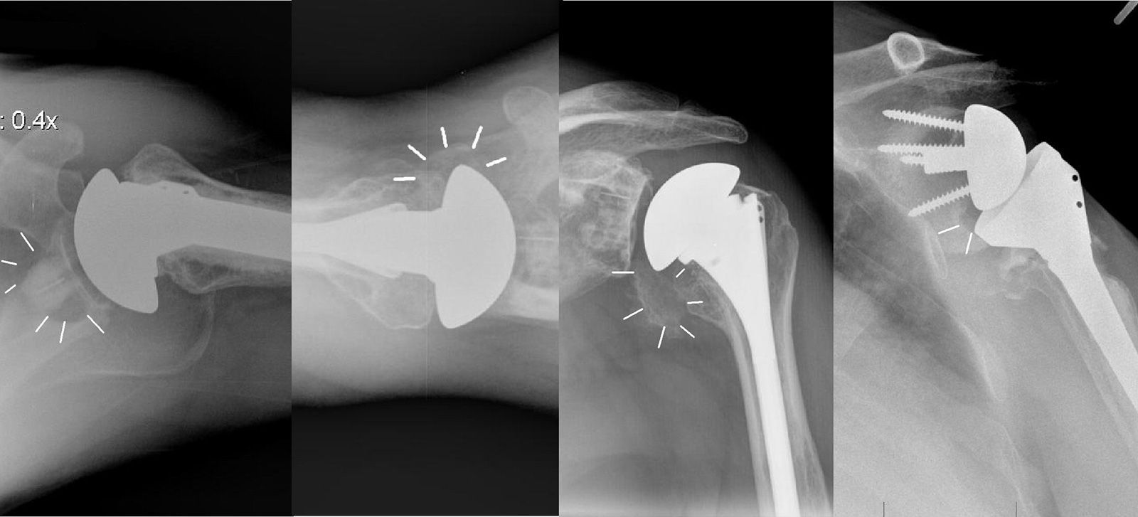Abb. 1-55: Das axiale Röntgenbild zeigt ausgedehnte Osteolysen des knöchernen Glenoids nach zementierter Fixierung der Glenoidkomponente (A). Pseudarthrose nach Osteotomie des Tuberculum minor zur Refixierung des Subscapularis bei einer primären totalen S