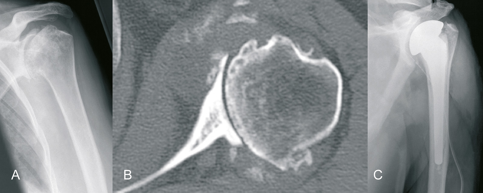 Abb. 1-56: Subluxation des Humeruskopfes und Arrosion des Glenoids (A,B) erschweren die Implantation einer Pfannenkomponente: Indikation für eine Hemiprothese (C) (Eigentum des Instituts für Klinische Radiologie der Universität Münster)
