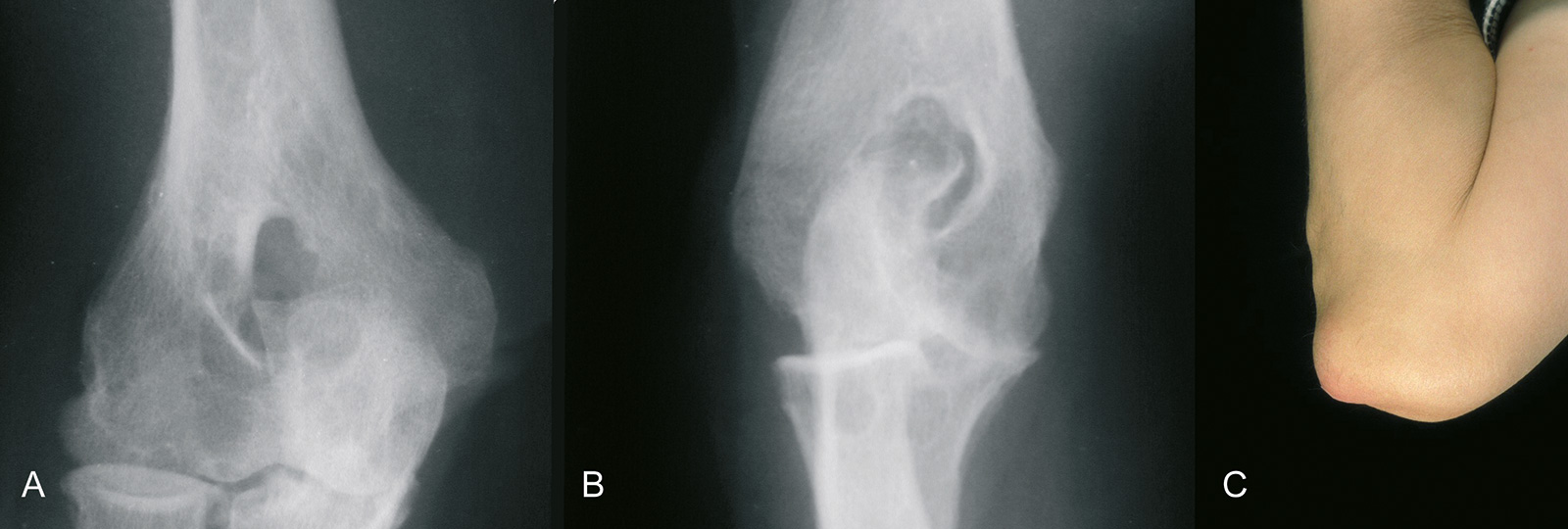 Abb. 1-72: Rheumatoide Arthritis des Ellenbogengelenks (A,B). Rheumaknoten im Bereich des Ellenbogens (C)
