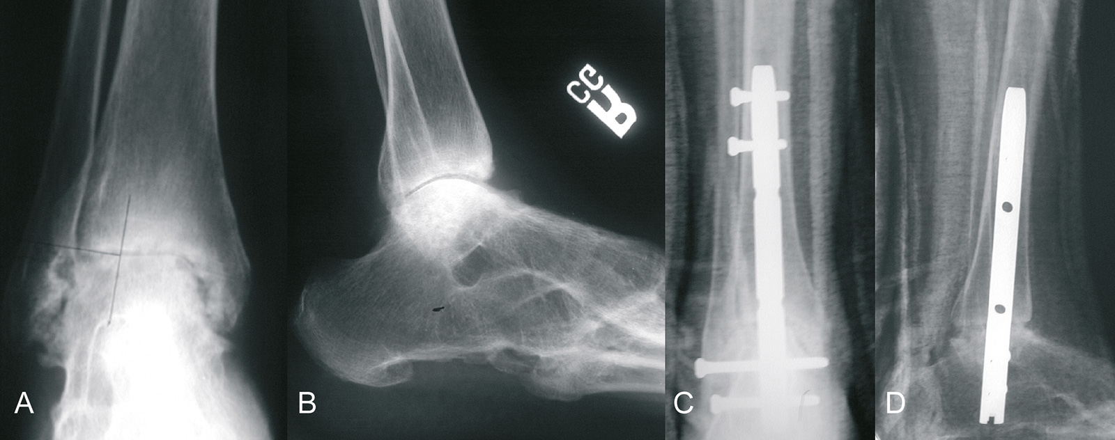 Abb. 1-73: Rheumatoide Arthritis des Sprunggelenks. Das untere Sprunggelenk und die Chopartgelenke sind bereits knöchern überbaut (A,B). Sprunggelenksarthrodese mit einem retrograden Nagel (C,D)