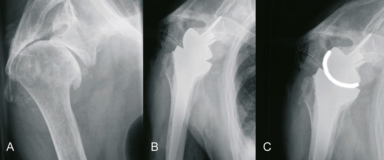 Abb. 2-15: Deltaprothese (B,C) bei schwerer Defektarthropathie (A) (Eigentum des Instituts für Klinische Radiologie der Universität Münster)