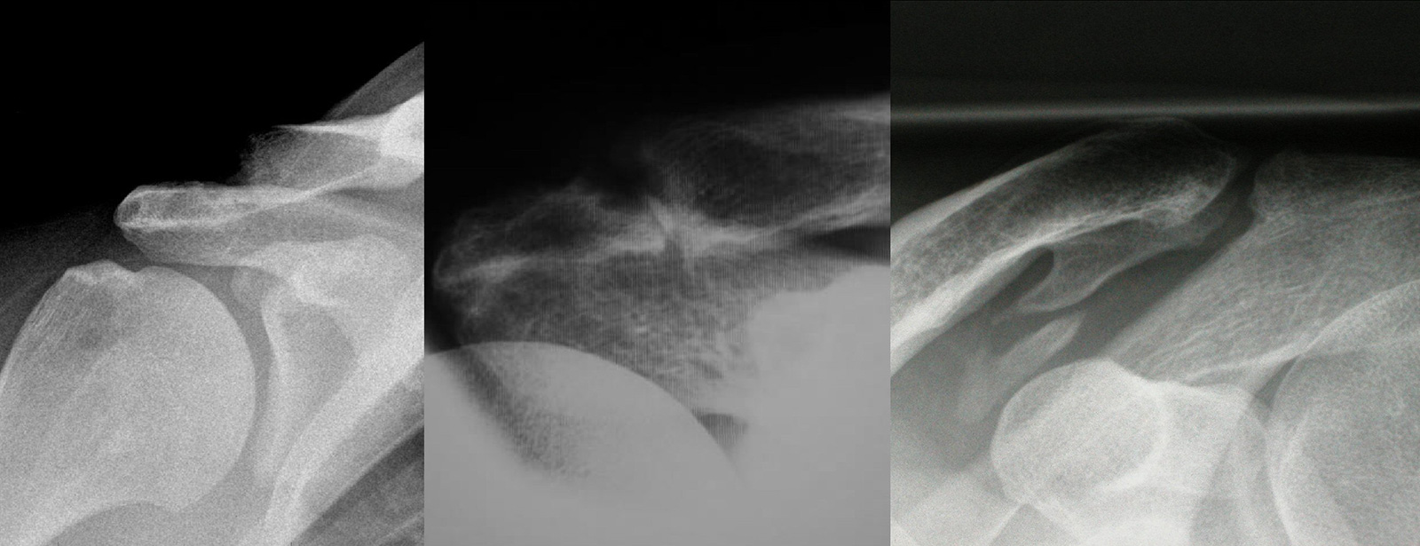 Abb. 2-22: Ausgedehnte AC-Gelenksarthrose (Röntgenbild Schulter AP (A) und Zanca Aufnahme (B)), bzw. Verkalkung des Lig. coracoclaviculare (C). Bei lokaler Druckschmerzhaftigkeit und Beschwerdelinderung durch eine AC-Gelenksinfiltration kann neben einer s