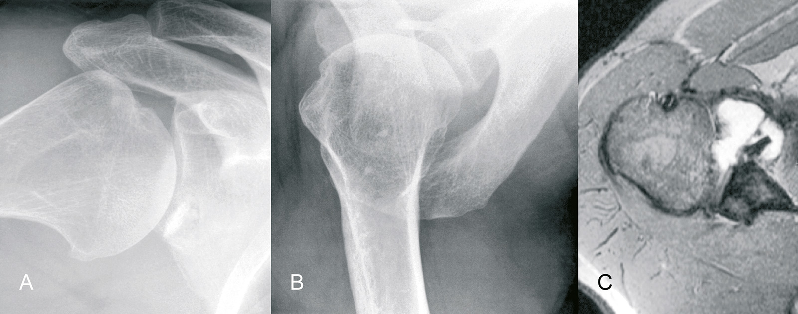 Abb. 2-27: Knöcherne Bankart-Fraktur im AP- und axialen Röntgenbild (A,B) und in der MRT-Bildgebung (C) nach einer vorderen Schulterluxation