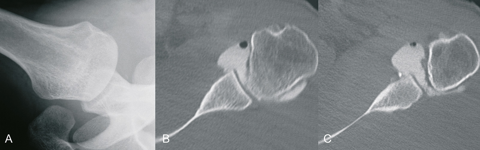 Abb. 2-28: Zustand nach rezidivierenden Schulterluxationen: natives Röntgenbild (A), die CT-Arthrografie (B,C) zeigt eine deutliche Weitung der Gelenkkapsel, sowie eine Verletzung des anterioren Labrums
