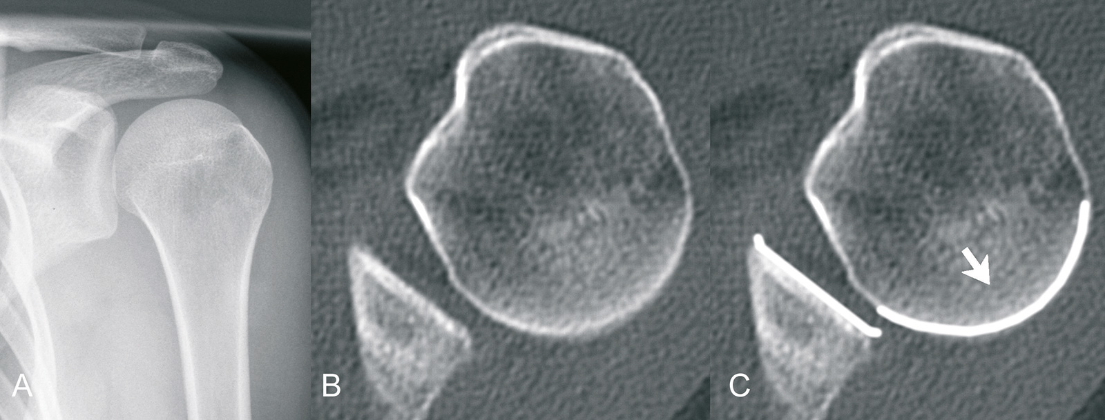 Abb. 2-34: hintere Schulterluxation: geringes „lightbulb sign“ in der Röntgenbildgebung (A), Subluxation in der Computertomografie (B,C)