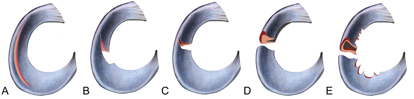 Abb. 2-49: Rupturformen: Korbhenkelriss (A), Lappenriss (B), Radiärriss (C), Horizontalriss (D), degenerative Meniskusveränderungen (E)