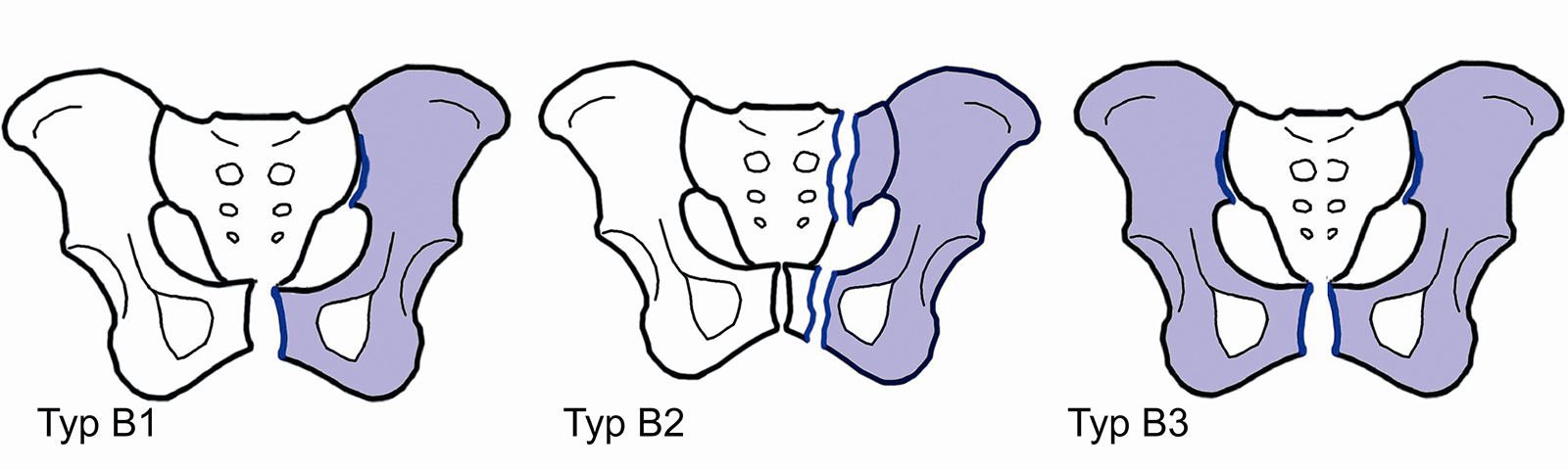 Abb. 3-13: ABC Klassifikation nach Tile: Beispiele für Typ B Frakturen (B2: entweder vorderer Beckenring oder Sakrum)