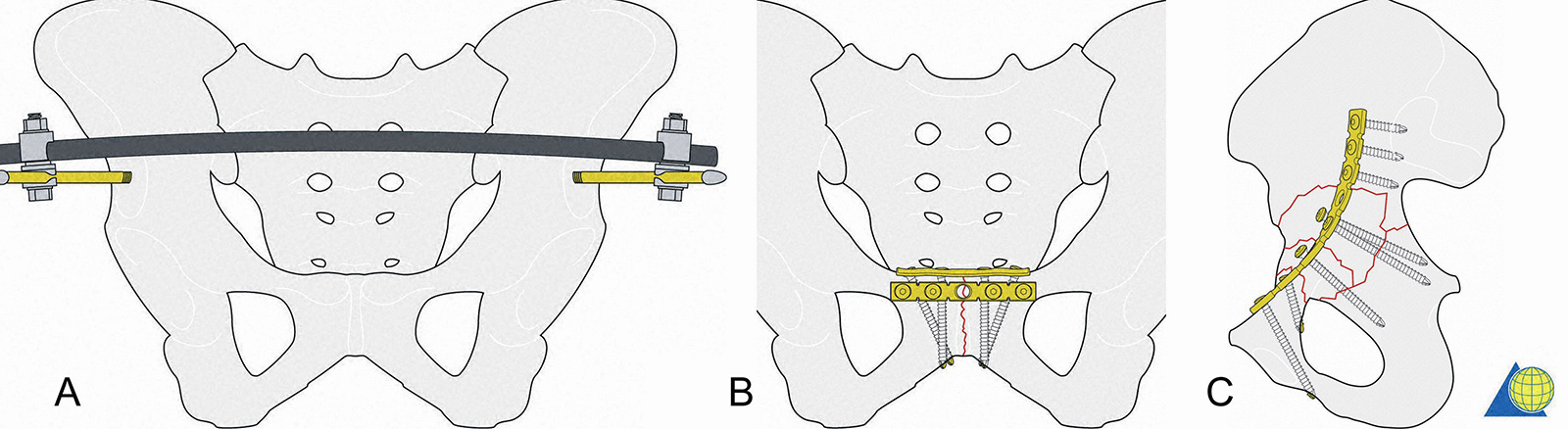 Abb. 3-16: Fixateur extern: Pins im Bereich der Spina ilica anterior inferior (A), Sicherung der Symphyse mit 2 5-Loch Platten (B), anteriore Fixierung mit mindestens 2 Schrauben in das Os pubis, 2 Schrauben in das Os Ilium und diversen Schrauben, die den