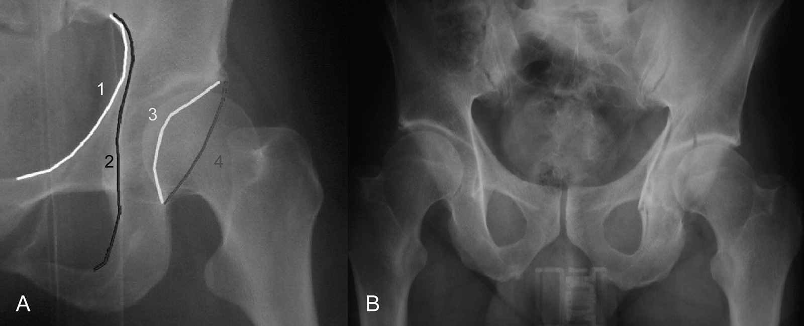 Abb. 3-18: Das knöcherne Acetabulum im Röntgenbild (A): Linea iliopectinea (1), ilio-ischiale Linie (2), vorderer Pfannenrand (3), hinterer Pfannenrand (4). Röntgenbild einer Acetabulumfraktur links (B)