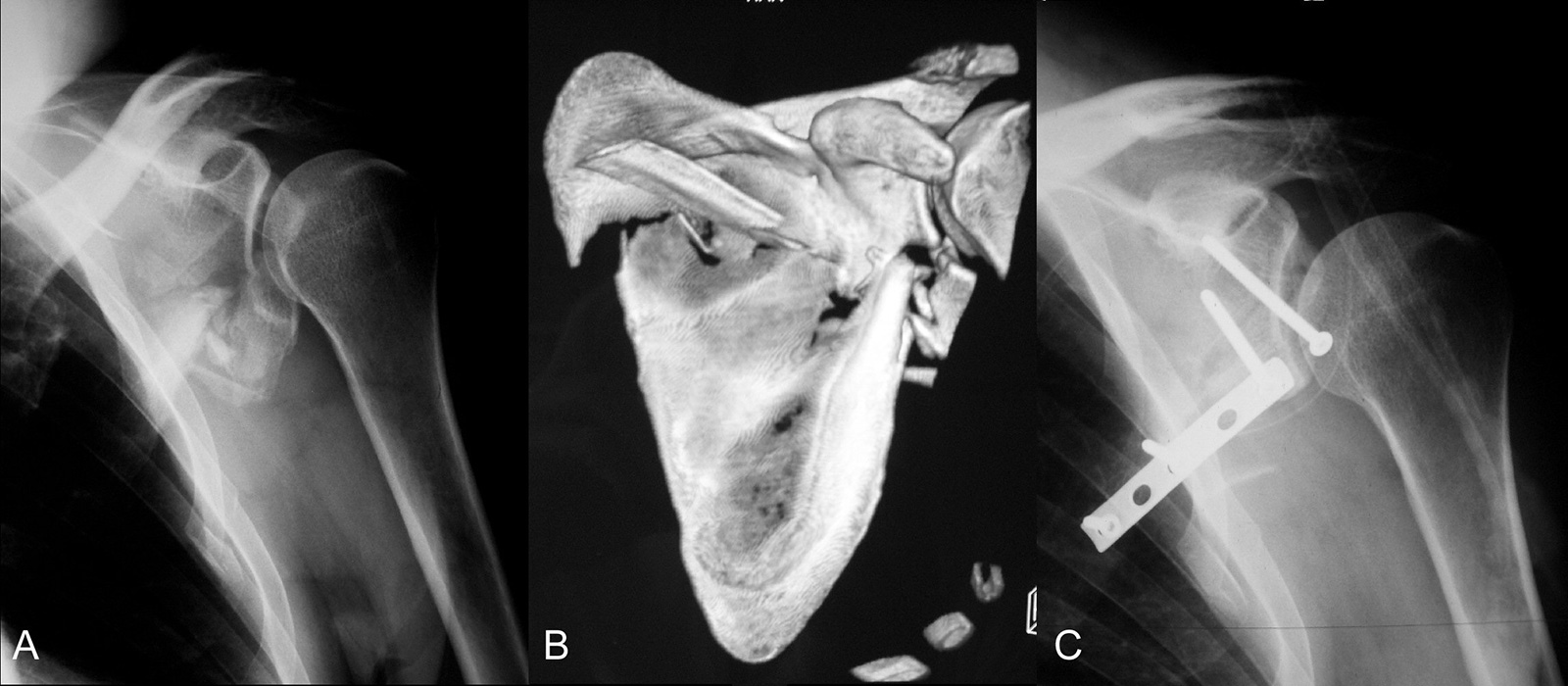 Abb. 3-64: intaartikuläre Scapulafraktur Typ 5 nach Ideberg: präoperative Röntgenbild und CT-Bildgebung (A,B) sowie postoperatives Röntgenbild (C)