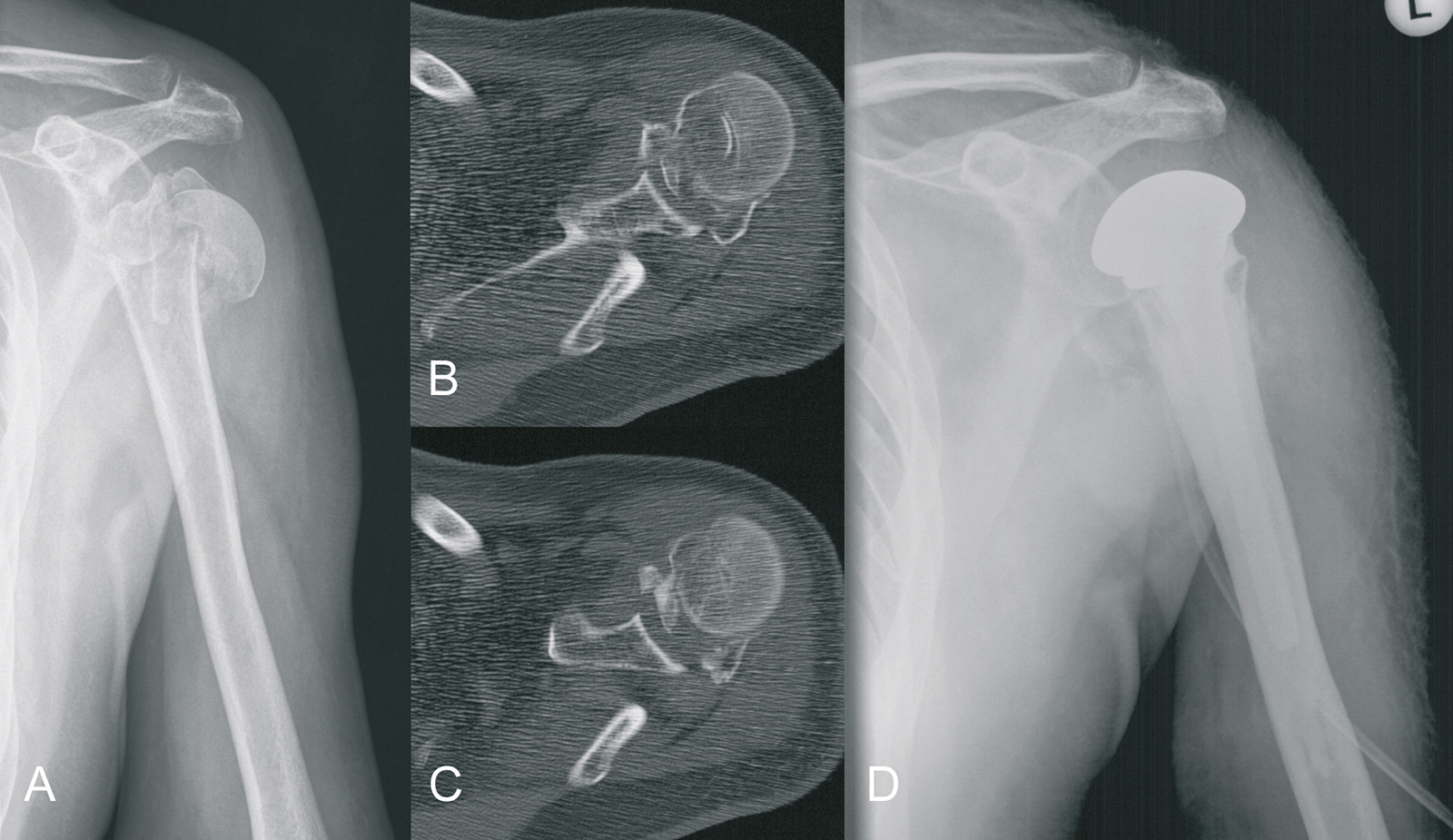 Abb. 3-71: Trümmerfraktur bei einer 74-jährigen Patientin: natives Röntgenbild (A), CT-Bildgebung (B,C), Röntgenbild nach Versorgung mit einer Hemiprothese (D)