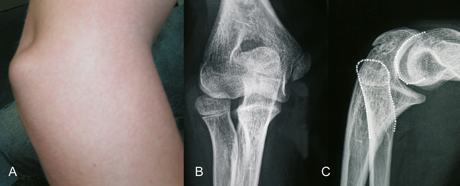 Abb. 3-82: Chronische Radiusköpfchenluxation bei einem 7-jährigen Jungen: klinisches Bild (A), natives Röntgenbild (B,C)