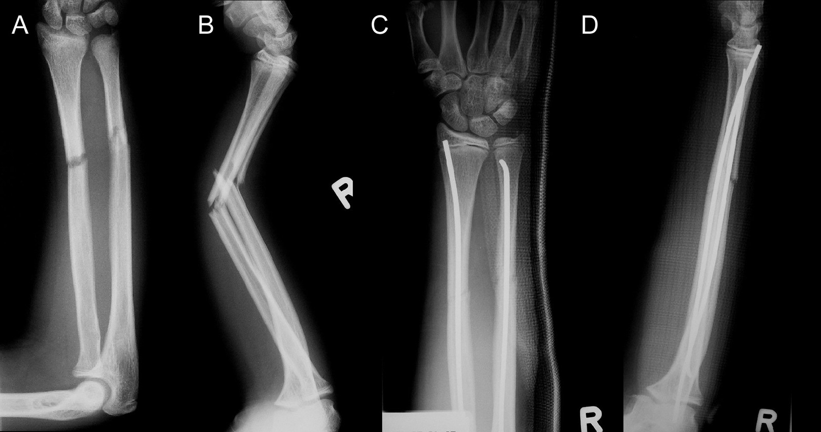 Abb. 3-86: Röntgenbild einer Unterarmfraktur beim Kind (A,B). Die Therapie erfolgte mit flexiblen Marknägeln (C,D)