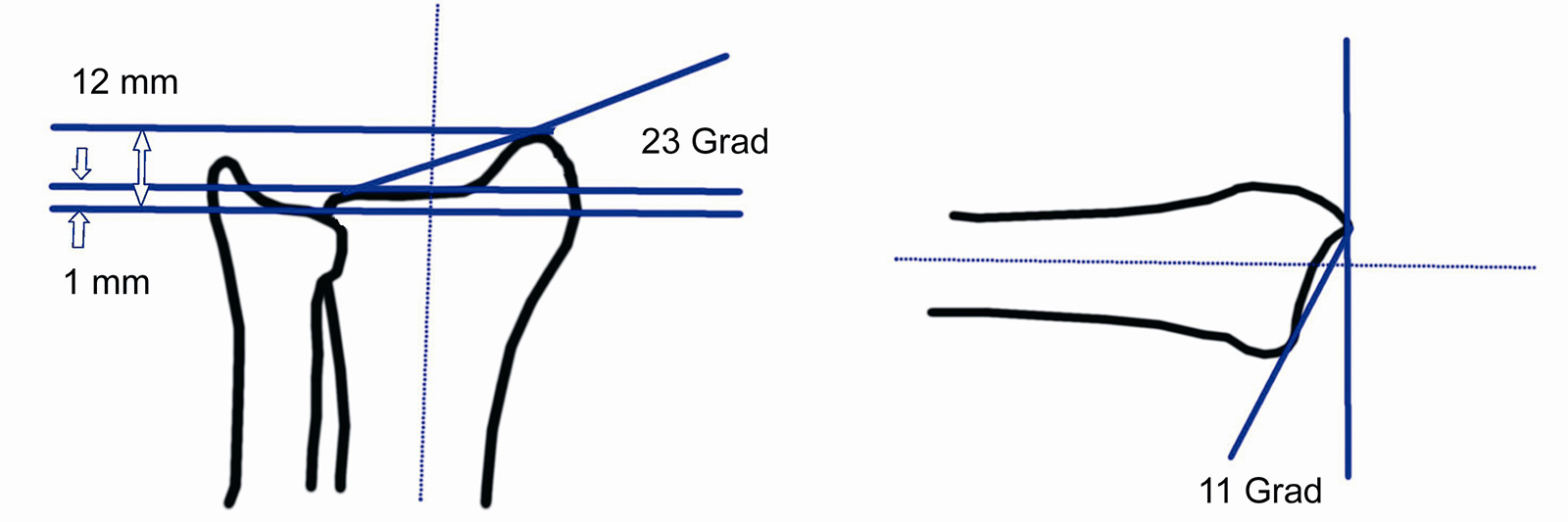 Abb. 3-87: Ausmaß der Ulna-Minus Variante, Ulnarinklination und Palmarinklination der radialen Gelenkfläche