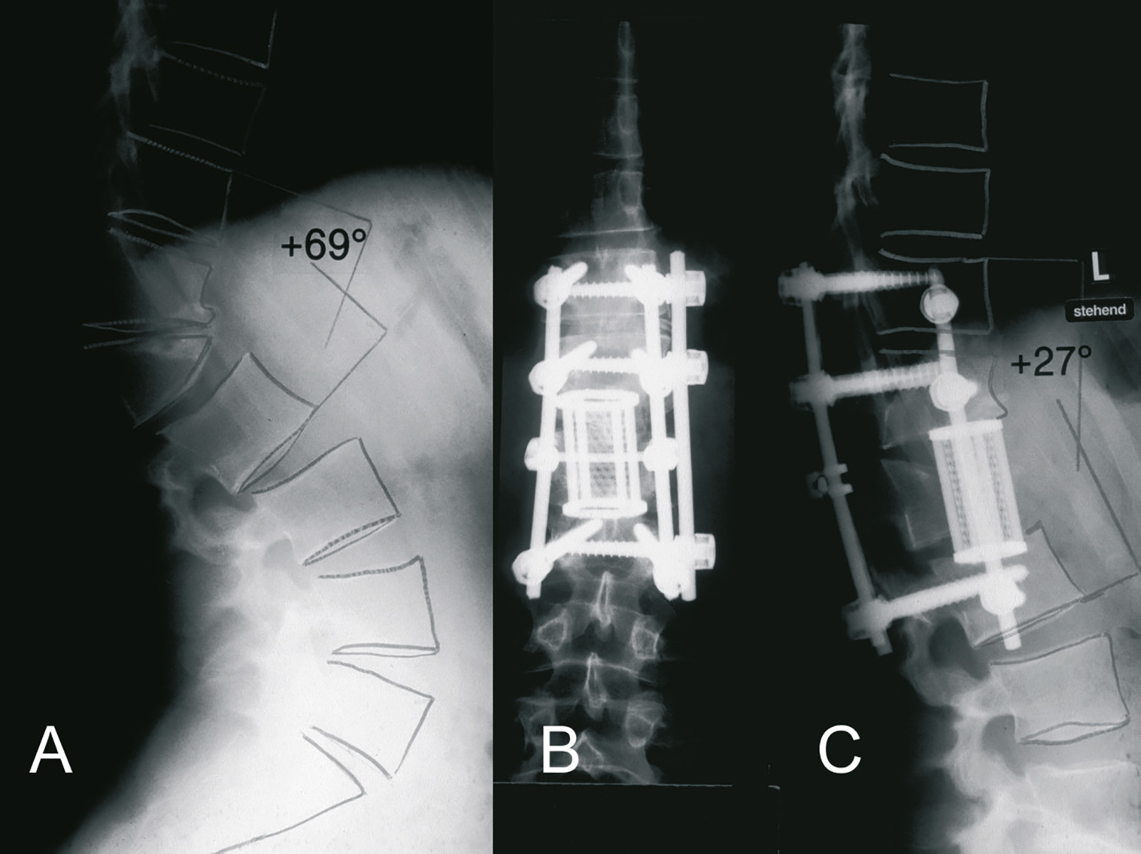 Abb. 3-9: LWK 1 Fraktur: Kombination aus dorsaler Spondylodese und ventraler Cageinterposition und Spongiosaplastik