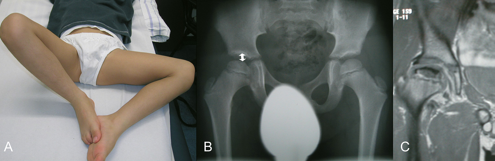 Abb. 4-14: Zu den initialen Zeichen gehört eine Einschränkung der Abduktion (positives Viererzeichen) (A), eine Verbreiterung des Gelenkspaltes im Röntgenbild (B) und typische Veränderungen im MRT (C)