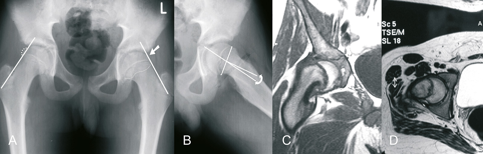 Abb. 4-21: Abbildung zeigt Bilder eines 14-jährigen Jungen mit einem Hüftkopfabrutsch: Klein’s Linie schneidet links nicht den Hüftkopf (A), Bestimmung des Abrutschwinkels in der LauensteinAufnahme (B), das MRT zeigt einen Abrutsch der Epiphyse nach media
