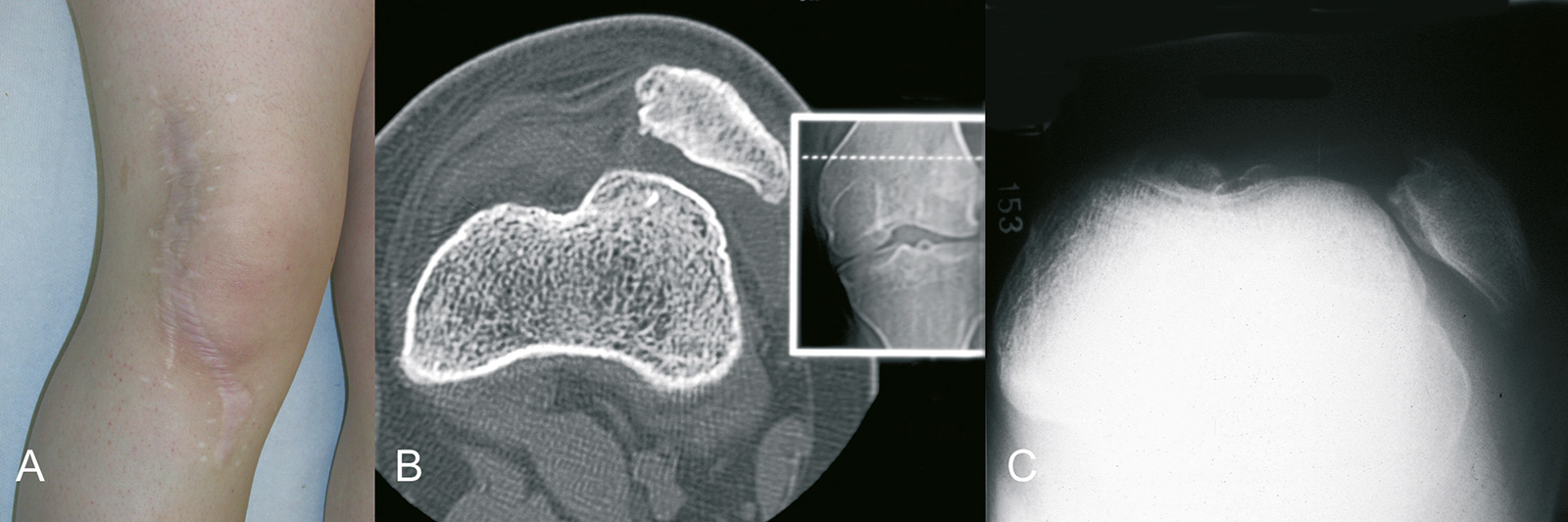 Abb. 4-30: Knie eines 15-jährigen Mädchens nach mehrfacher Operation (A), und einem Rezidiv der Patellaluxation (B-C)