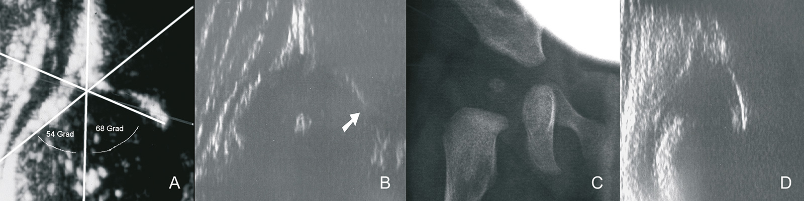 Abb. 4-3: Typ 1A (A), sobald der Hüftkopf ossifiziert, ist der Unterrand des Os iliums im Ultraschall nicht mehr darstellbar (B-C), Typ 4 (D)
