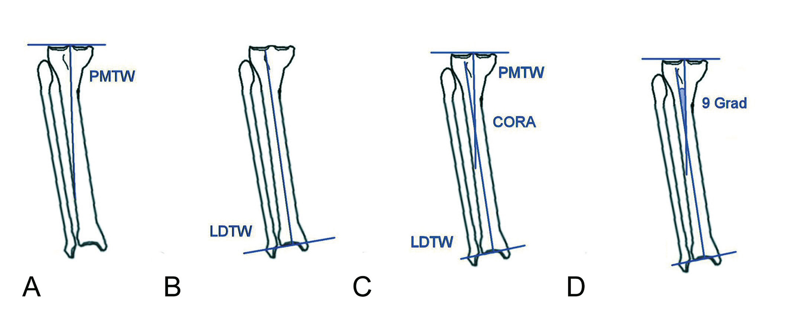 Abb. 4-39: Analyse einer Tibiadeformität: proximaler medialer Tibiawinkel (A), laterale, distaler Tibiawinkel (B), Center of Rotation and Angulation (C), Ausmaß der Deformität (D)