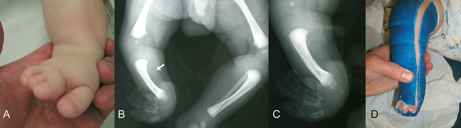 Abb. 4-45: Fibulaaplasie rechts (A-C), Anlage eines Gipses zur Korrektur der Pronationsfehlstellung nach der Geburt (D)