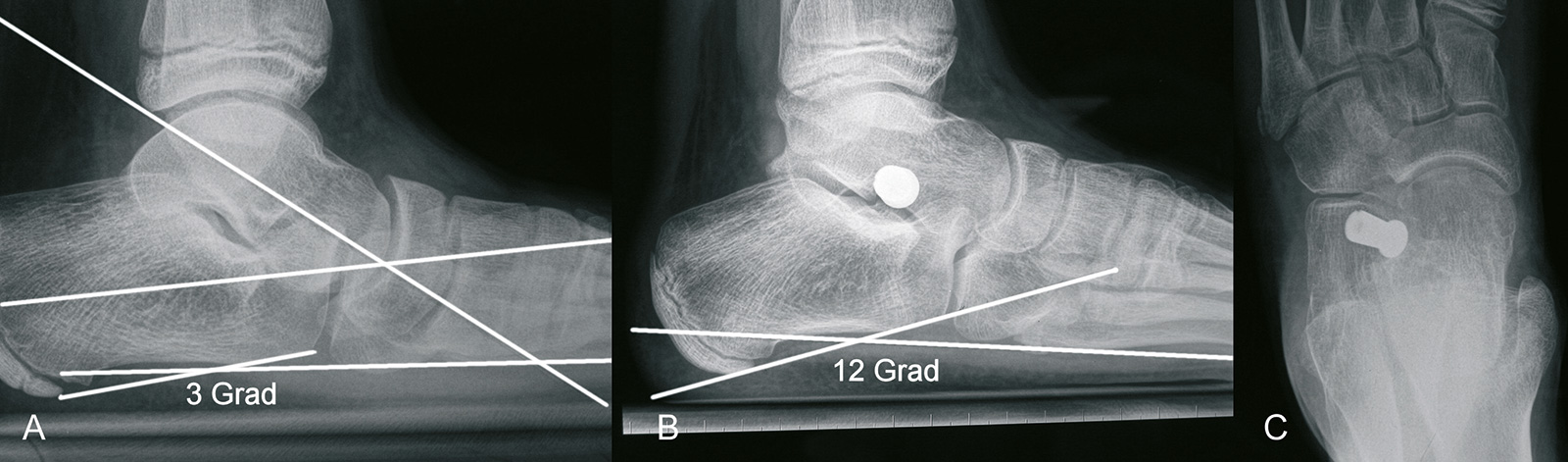 Abb. 4-59: Korrekur eines Knicksenkfußes (A) mit einem Kalix Implantat (B-C)