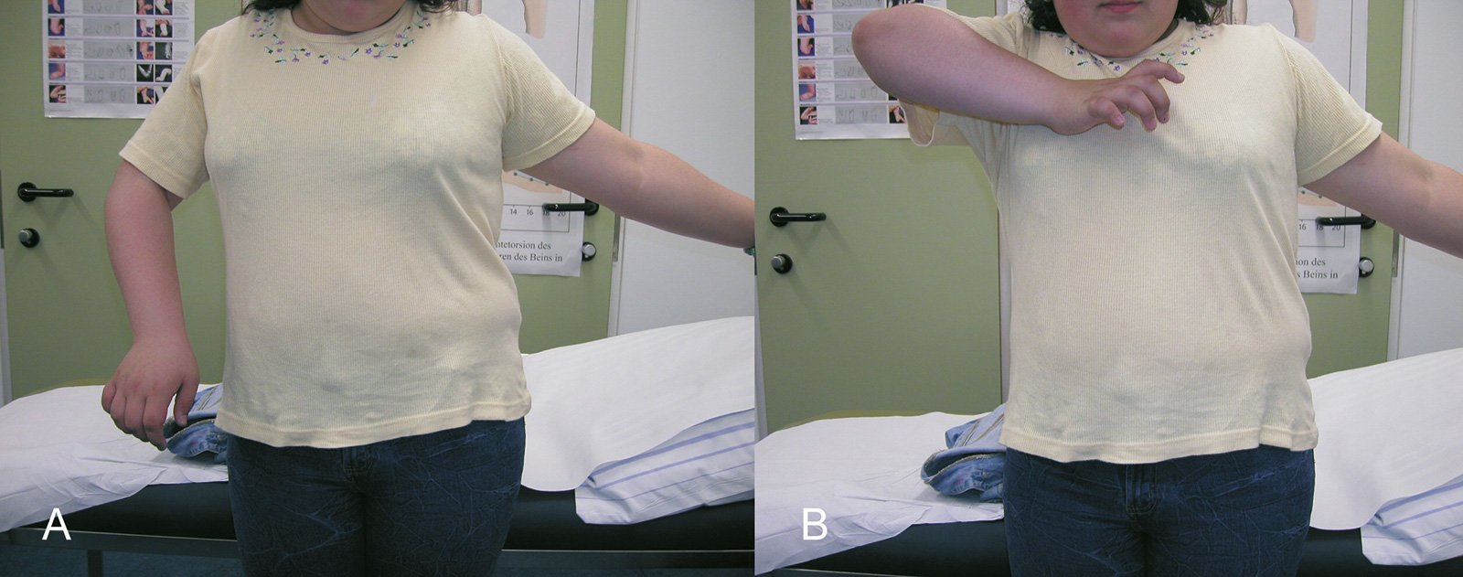 Abb. 4-68: Patientin mit einer Erbschen Lähmung. Der Arm wird in Innenrotation gehalten (A) und die Abduktion ist eingeschränkt (B)
