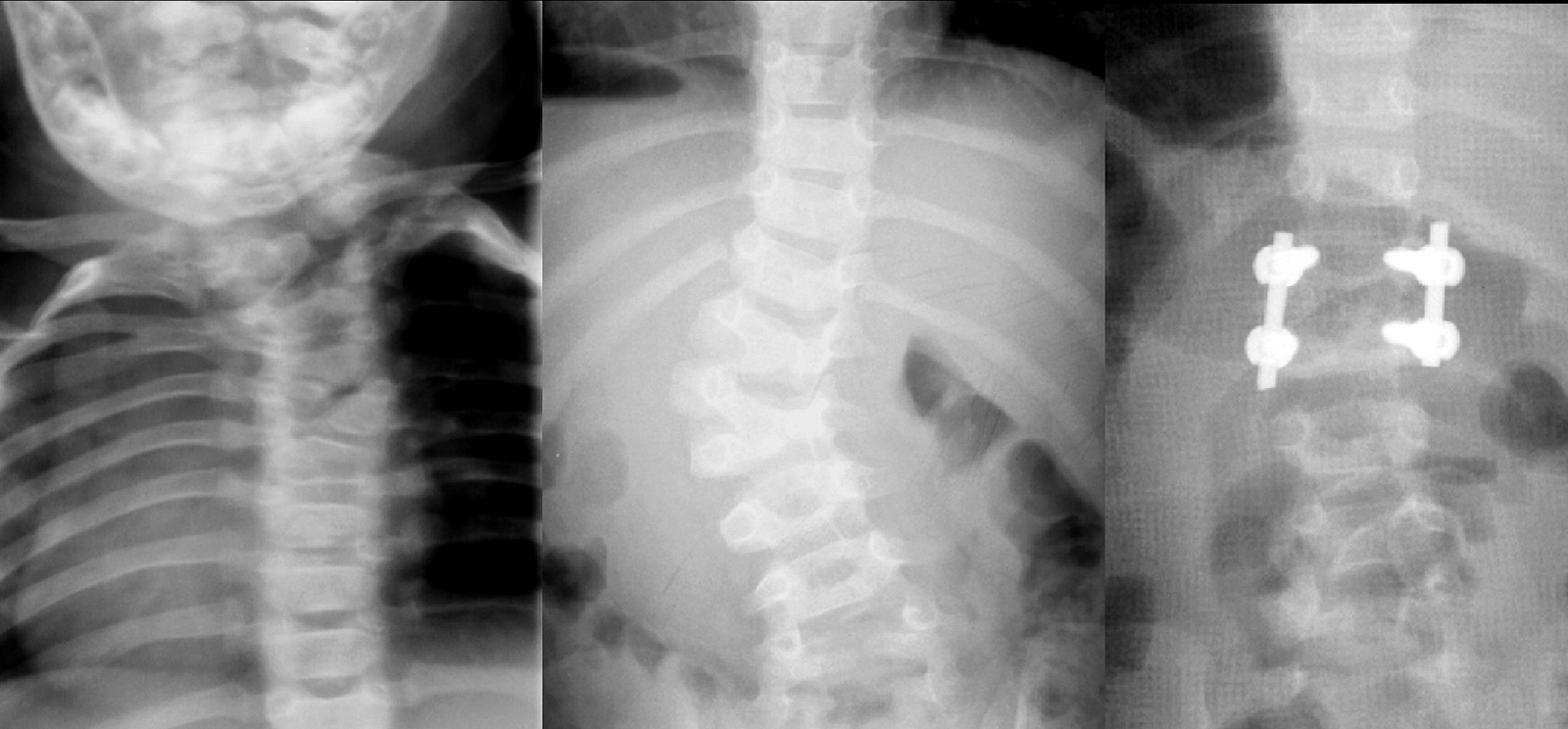 Abb. 5-18: Röntgenbild einer infantilen Skoliose aufgrund einer Segmentationsstörung der oberen Brustwirbelsäule (A) und des thorakolumbalen Übergangs (B). Letztere wurde mit einer Halbwirbelresektion in Kombination mit einer dorsalen Fusion versorgt (C)