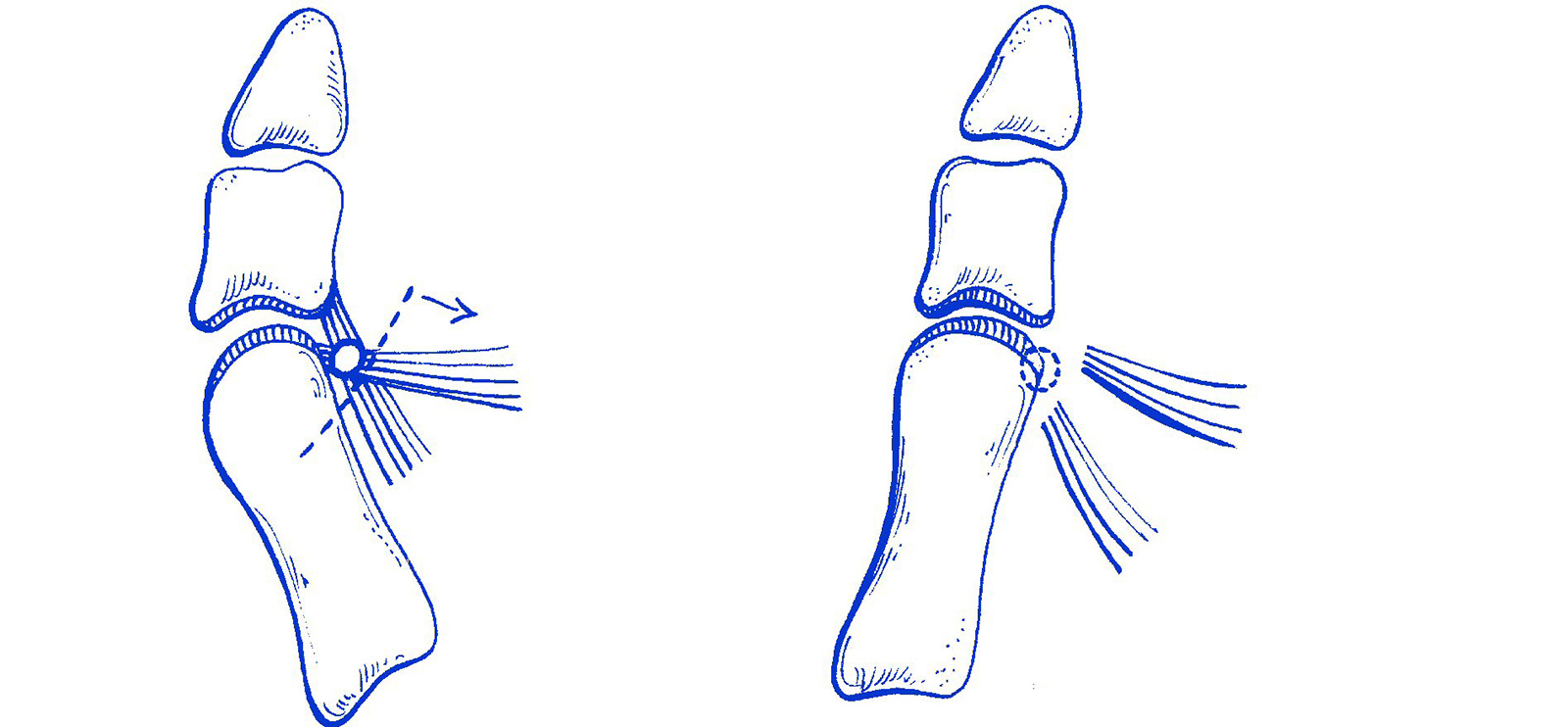 Abb. 6-10: Schemazeichnung eines distalen Weichteilreleases der Sehne des M. adductor hallucis
