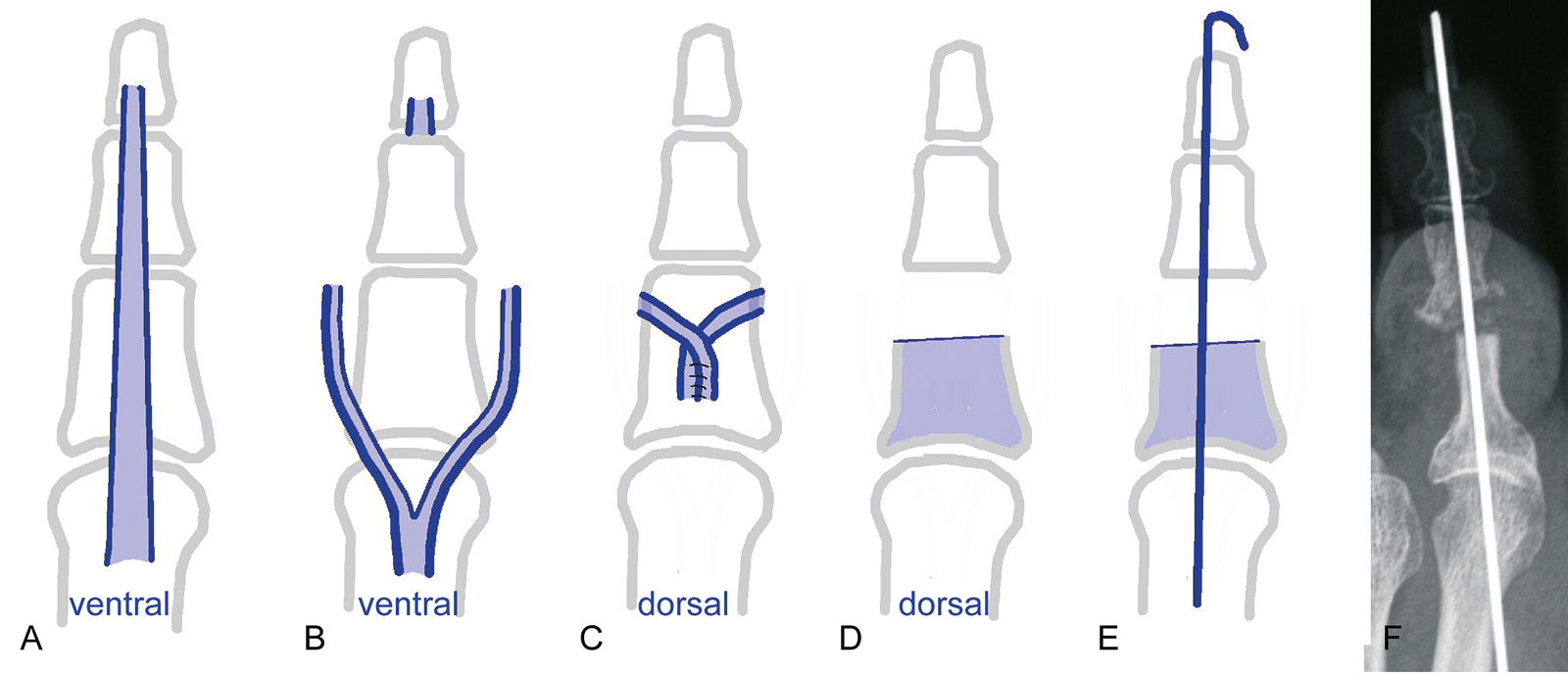Abb. 6-16: Operation nach Girdlestone (A-C): Sehne des Flexor dig. longus (A) wird gespalten (B) und plantar um die Phalanx geschlungen und dorsal vernäht (C); Operation nach Hohmann: Resektion des Köpfchens der proximalen Phalanx (D) und Ausrichtung mit 