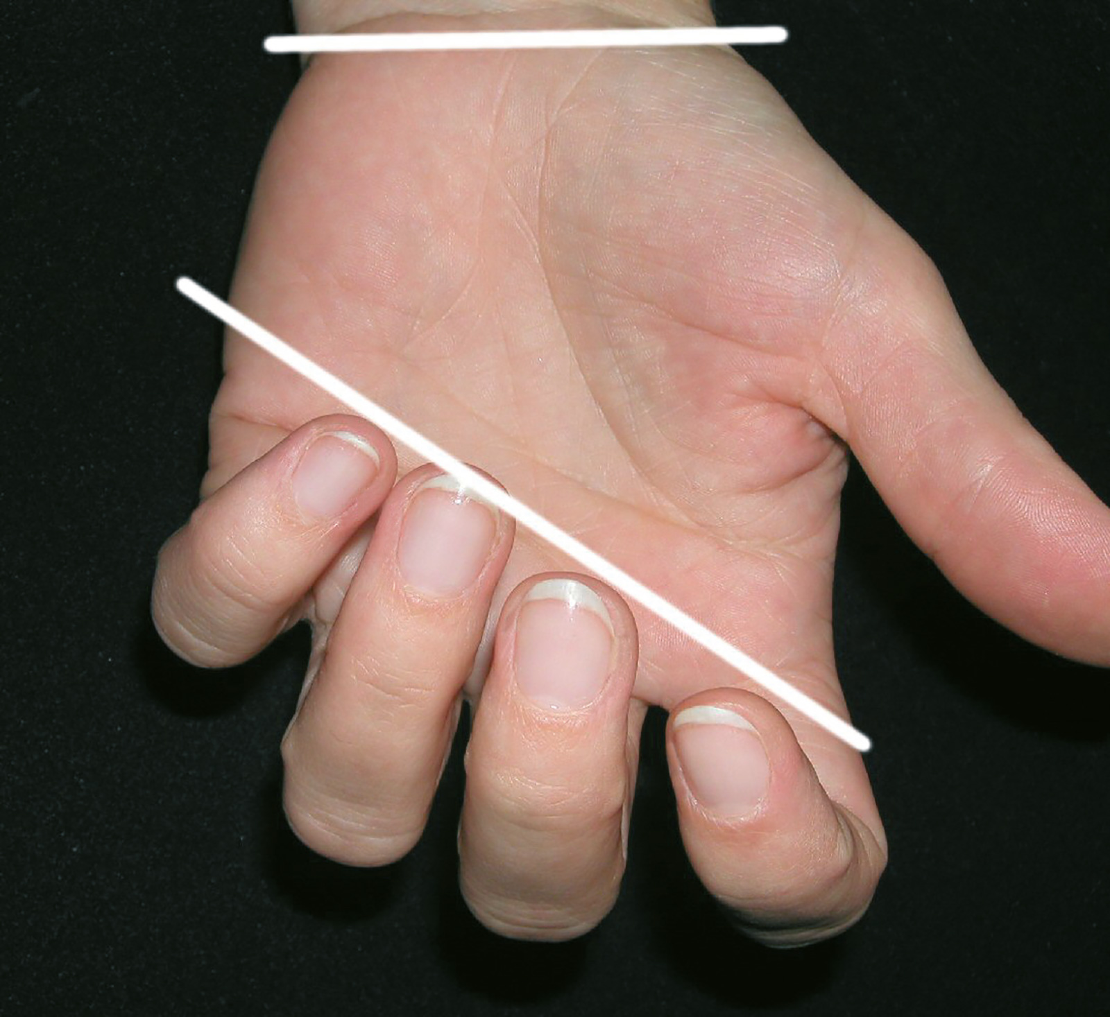 Abb. 7-15: Haltung der Finger für optimale Spannung der Beugesehne bei der Sehnennaht