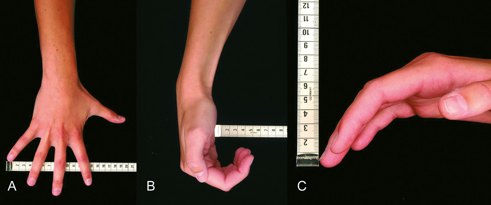 Abb. 7-30: Fingerspreizung in den Grundgelenken (A), Quantifizieren der Fähigkeit zum Faustschluss (B,C)