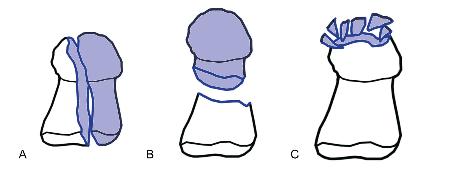 Abb. 7-3: Frakturen der distalen Phalanx: Längsbruch (A), Querbruch (B) und Nagelkranztrümmerbruch (C)