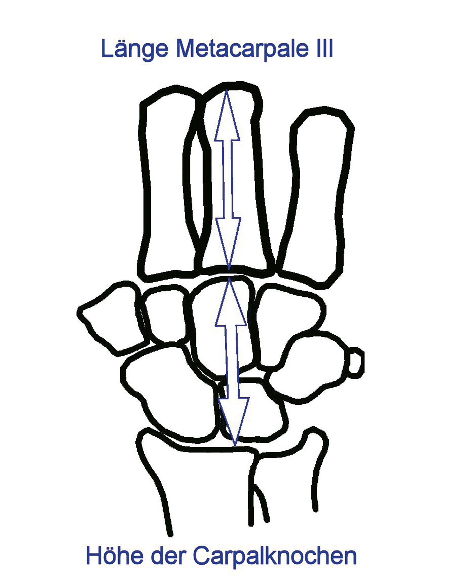 Abb. 7-32: Verhältnis der Höhe der Handwurzelknochen geteilt durch die Länge des Metacarpale III beträgt etwa 0.54 (Youm Y, Flatt AE. Kinematics of the Wrist. Clin Orthop 1980; 149: 21-32)