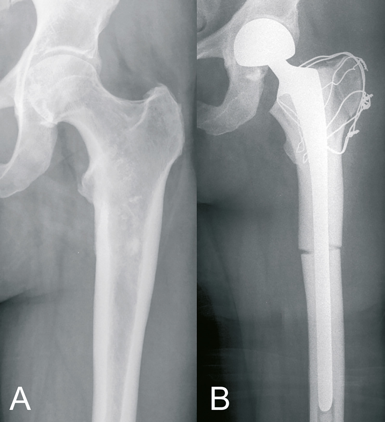 Abb. 8-16: Allograft-Composite-Prothese. (Eigentum des Insituts für Klinische Radiologie der Universität Münster)