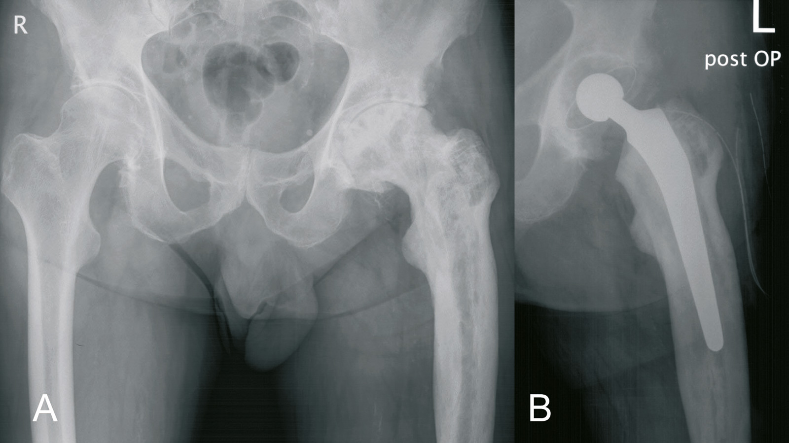 Abb. 8-36: Implantation einer Hüftprothese (B) bei sekundärer Arthrose auf der Basis eines M. Paget (A) (Eigentum des Insituts für Klinische Radiologie der Universität Münster)