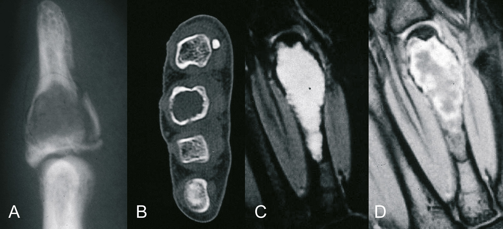 Abb. 8-47: Enchondrom der distalen Phalanx (A) und des Metacarpale 2 (B-D) (Eigentum des Instituts für Klinische Radiologie der Universität Münster)