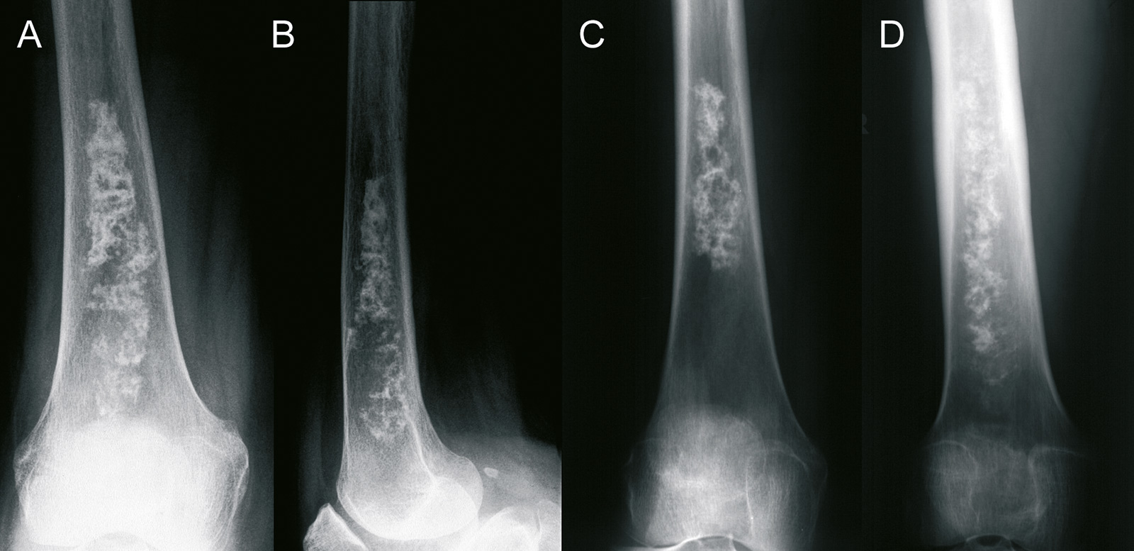 Abb. 8-48: Differentialdiagnose: Beispiele für einen Knocheninfarkt im Bereich des distalen Femurs (A-D) (Eigentum des Instituts für Klinische Radiologie der Universität Münster)