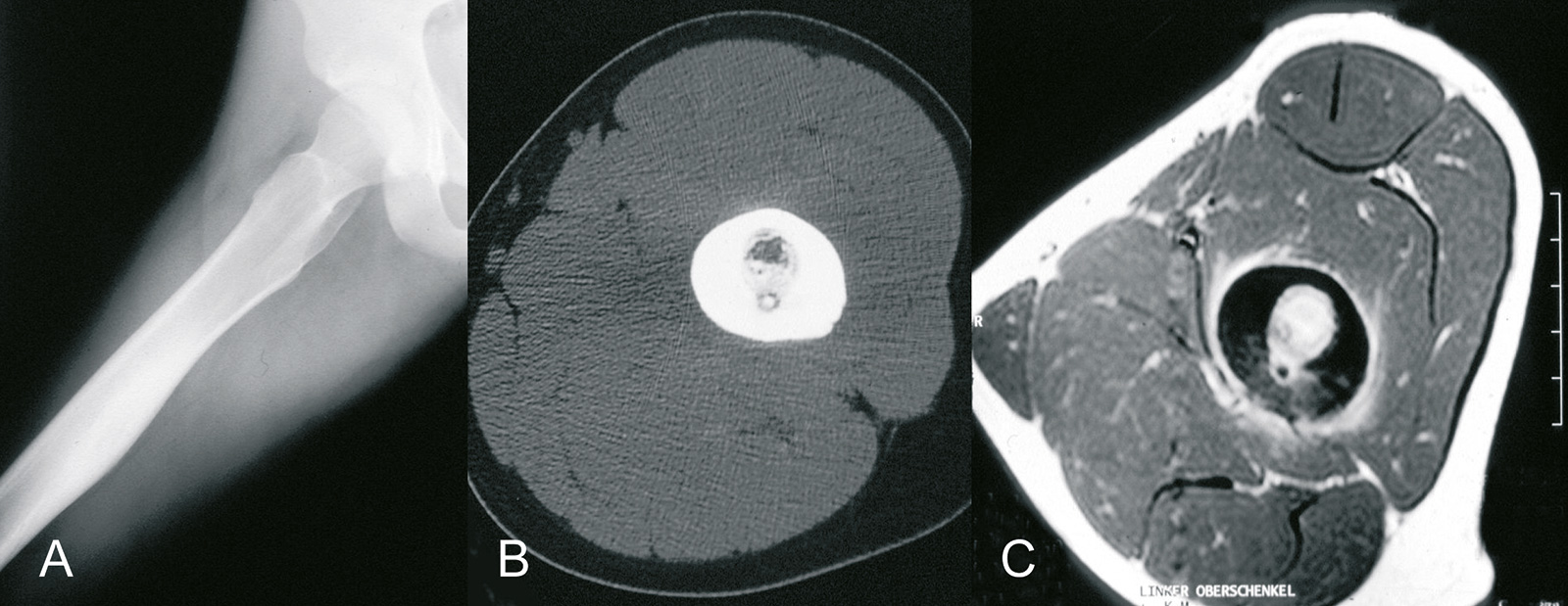 Abb. 8-54: Osteoidosteom der Femurdiaphyse: natives Röntgenbild (A), CT - (B) und MRT Bildgebung (C) mit typischer zentraler Verkalkung (B,C) (Eigentum des Instituts für Klinische Radiologie der Universität Münster)